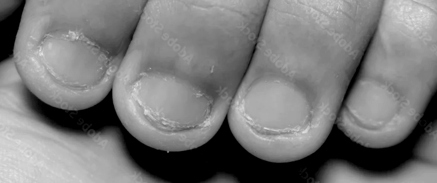 Bitten Nails