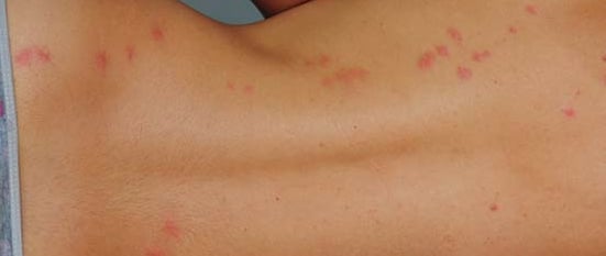 Mntreal Bed Bug Bites