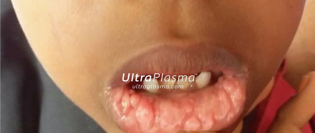 ultraplasma.com_wart_treatment_sigil_tedavisi_ultra_plasma_ultra_plazma_mouth_agiz