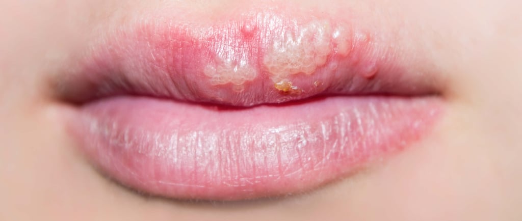 herpes after lipblush, feu sauvage aprés lipblush