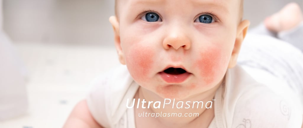atopic_dermatitis_atopic_dermatit_egzama_eczemaultra_plasma_ultra_plazma_ultra-plasma_ultra-plazma