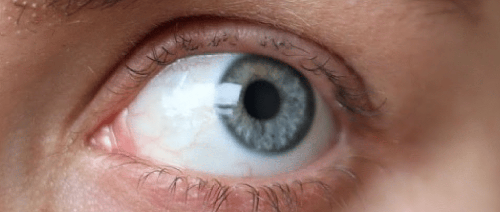 Plus de clis après un lashlift trop tôt, oeil bleu vert avec peu de cils