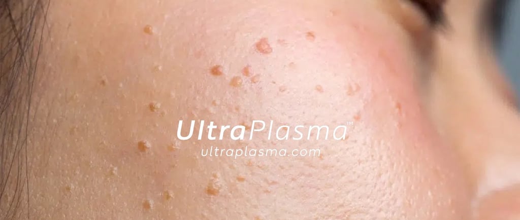 ultraplasma.com_wart_treatment_sigil_tedavisi_ultra_plasma_ultra_plazma_mouth_agiz