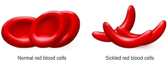 Sickle Cell 