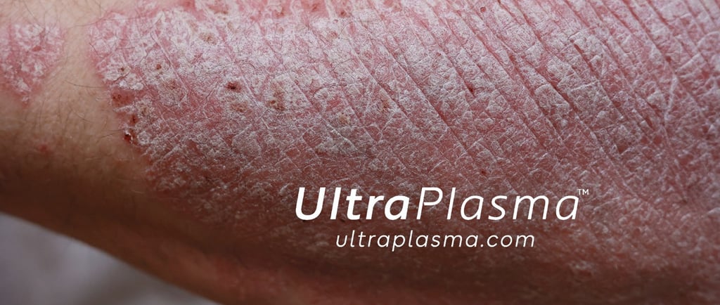 ultraplasma.com ultra plasma ultra plazma psoriasis sedef treatment tedavi