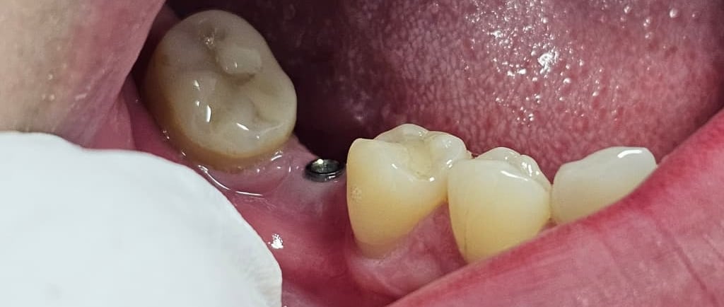 Servicio de implantes en Badajoz