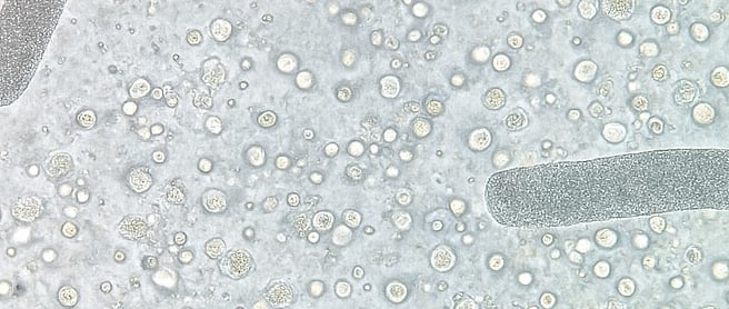 urina vista do microscopio com cilindros urinarios