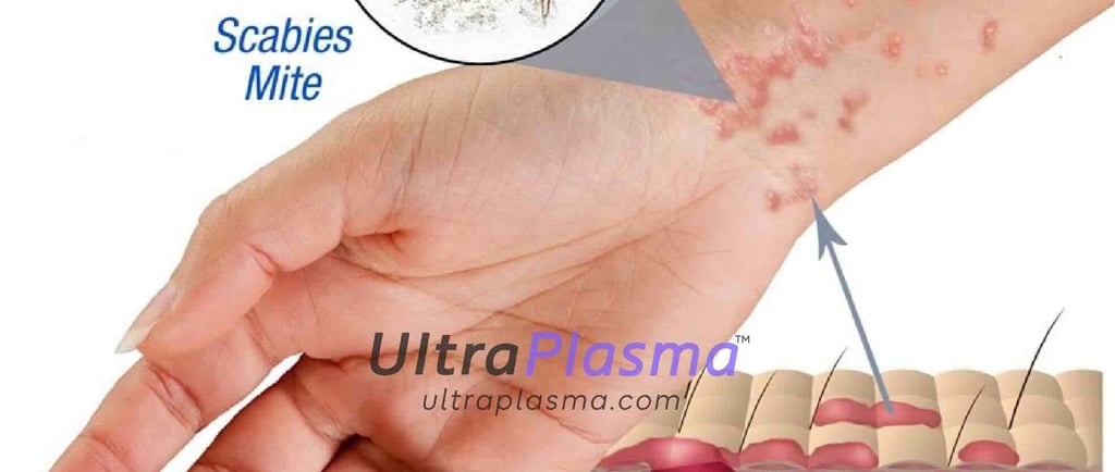 ultraplasma.com_Sarcoptes_scabiei_Infestation_Treatment_ultra_plasma_ultra_plazma