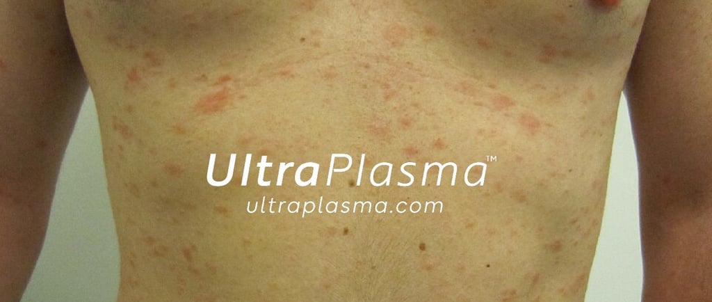 ultraplasma.com_Pityriasis_Rosea_treatment_ultra_plasma_ultra_plazma_1