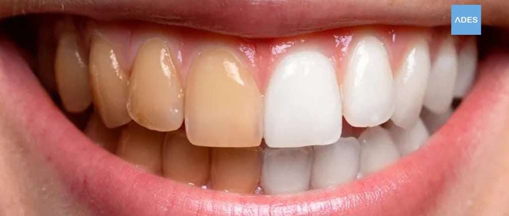 blanqueamiento dental