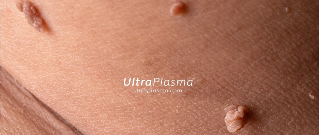 ultraplasma.com_wart_treatment_sigil_tedavisi_ultra_plasma_ultra_plazma_genital