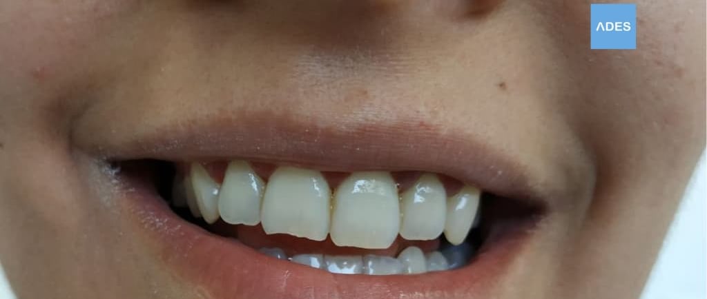 clinica dental ades ortodoncia infantil