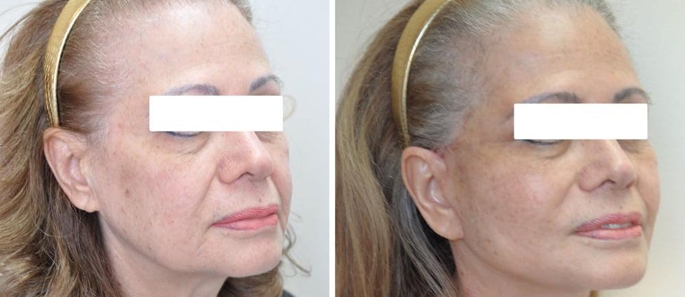 Yüz Germe (Facelift) Vaka