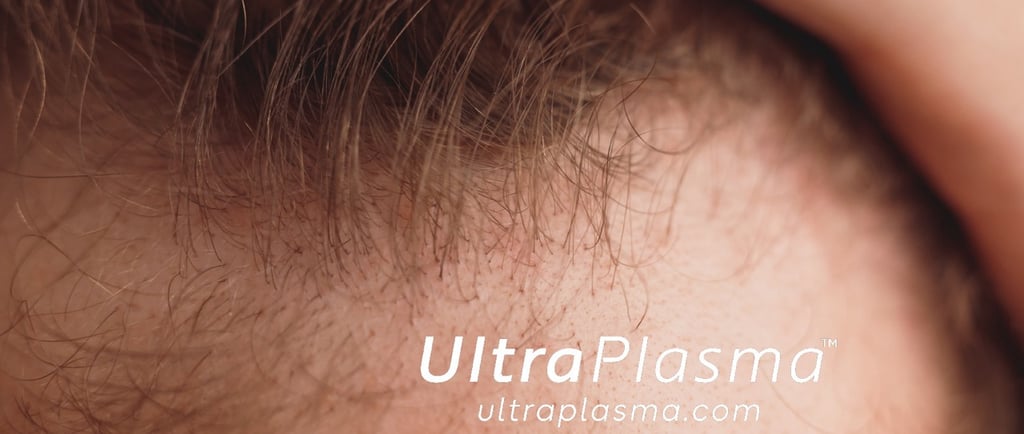 ultraplasma.com ultra plasma ultra plasma hair loss thin hair growth activation treatment