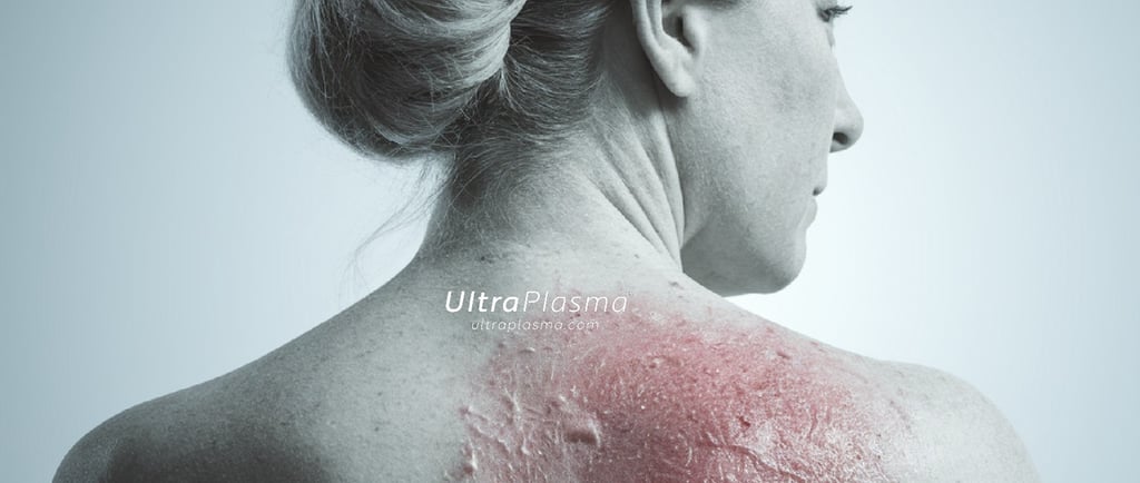 ultraplasma.com_Varicella_zoster_herpes_zoster_zona_tedavisi_treatment_ultra_plasma_ultra_plazma