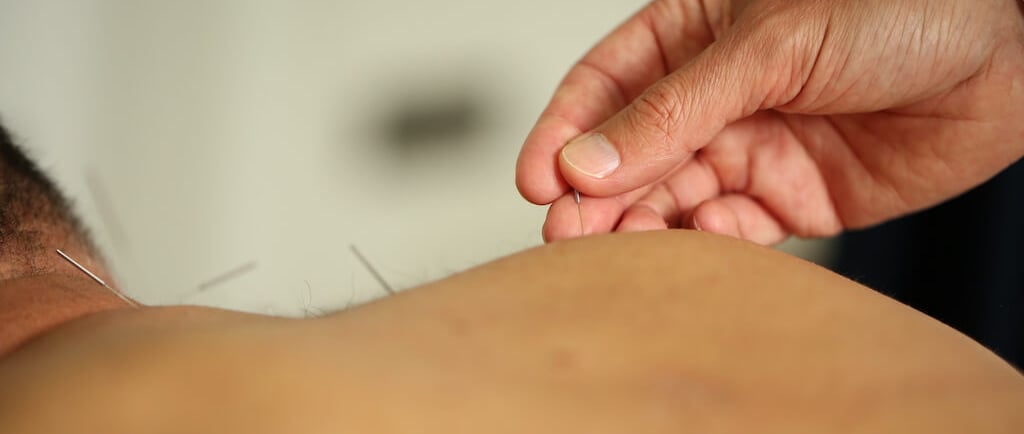 acupuntor insertando una aguja en la espalda