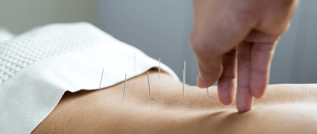 Close-up of acupuncture needles placed on woman's lower back for fertility