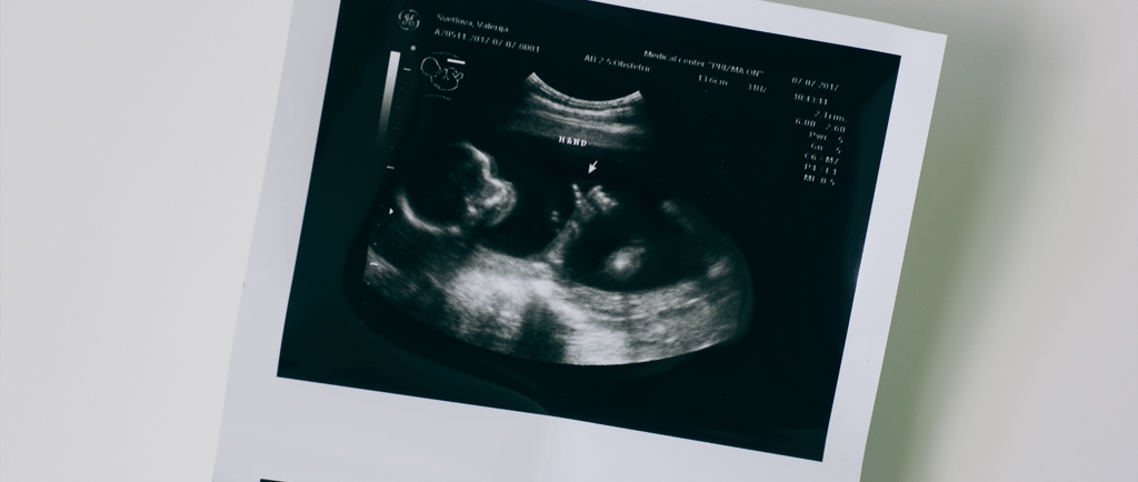Printed ultrasound image of an IVF pregnancy scan on white surface