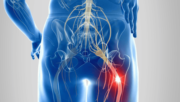 sciatique etiopathie