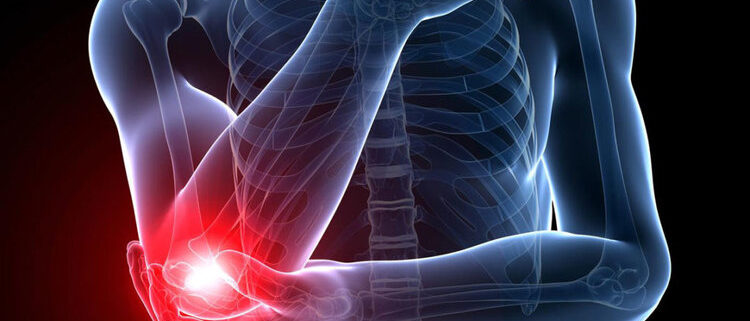 épicondylite etiopathie