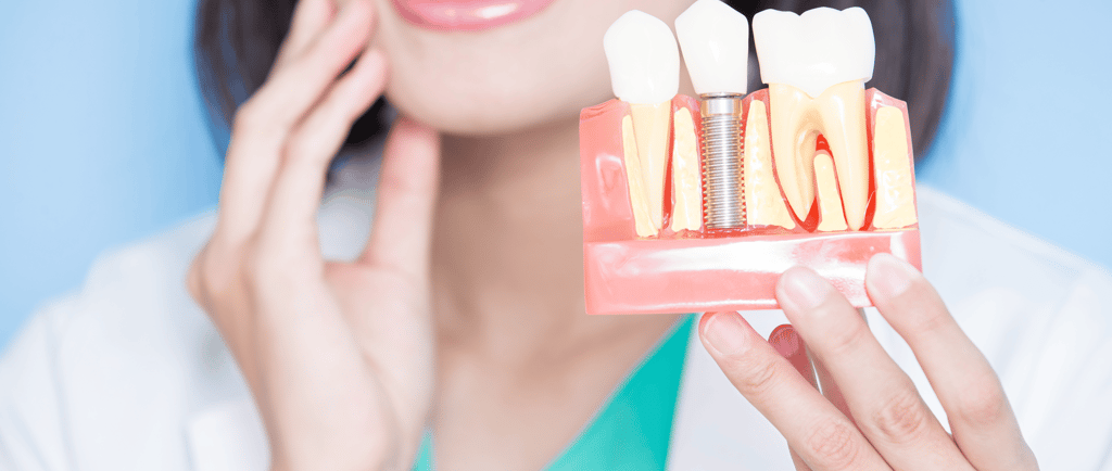 Best Dental Implants in Vashi, Ghansoli | kopar khairane Navi Mumbai, India, Near me