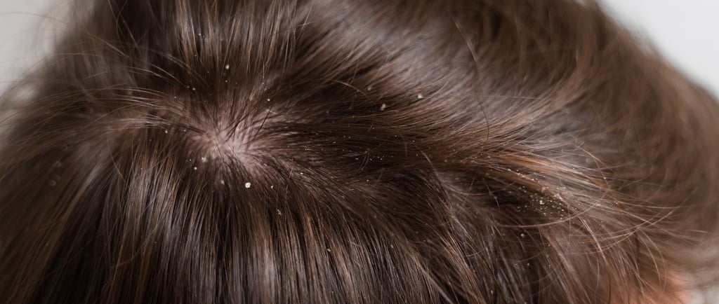Dandruff in hair