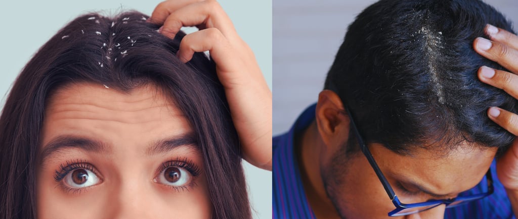 man and woman with dandruff