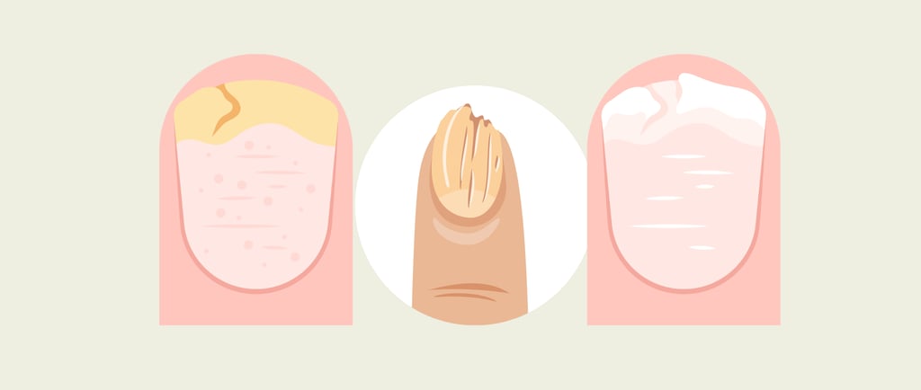 Broken and discolored fingernails