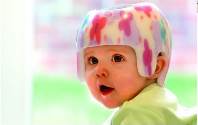 Plagiocefalia - Órtese Craniana