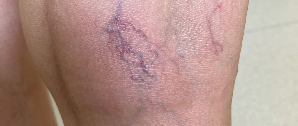 a woman with a varix on her leg