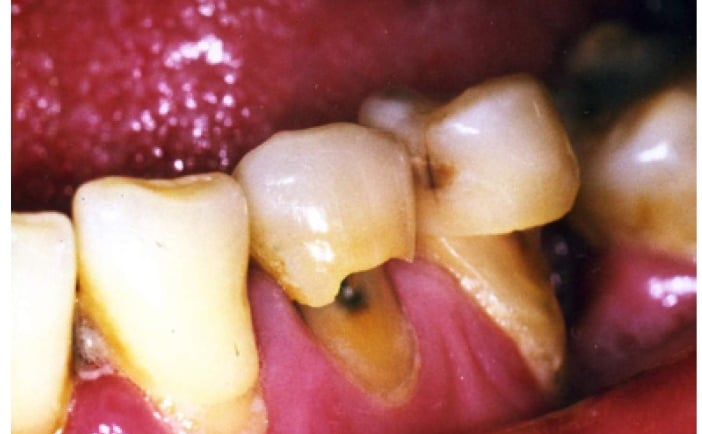 a image showing dental abrasion in teeth