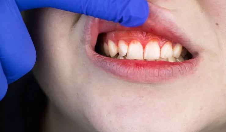 bleeding gums while brushing in kids