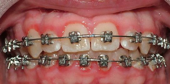an image showing swolllen gums with braces