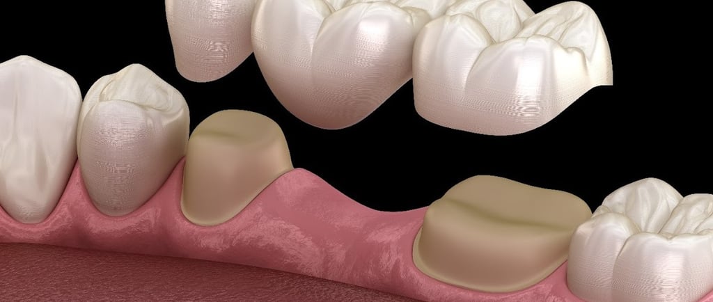 a dental bridge connecting premolar and molar teeth