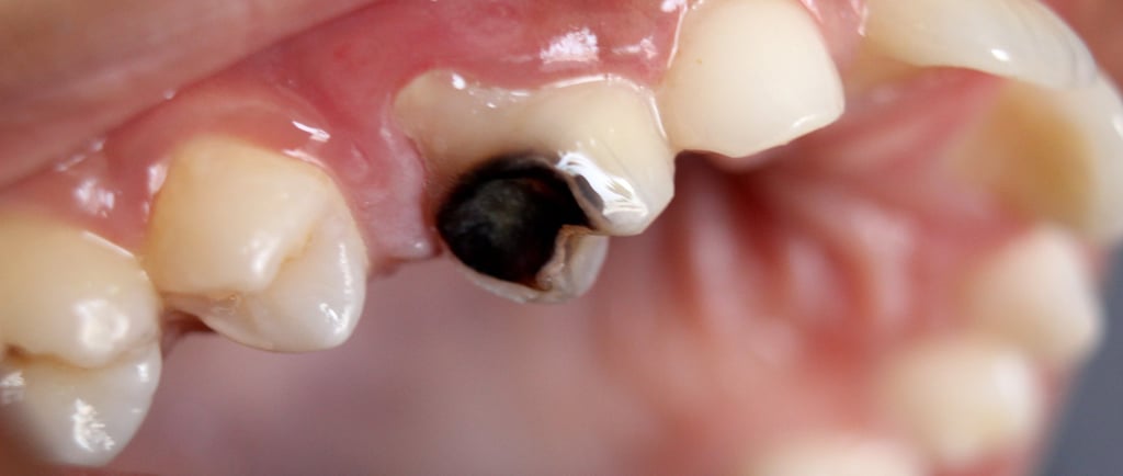 a image showing severly decayed tooth requiring root canal treatment