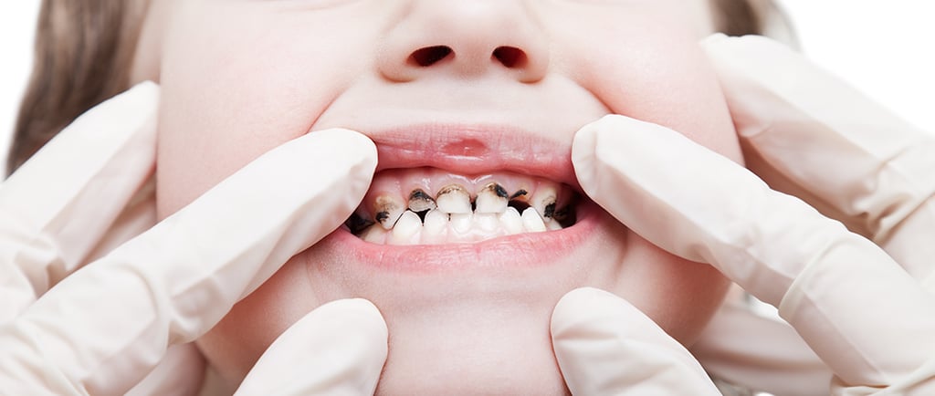 a image showing a girl's mouth with decayed tooth