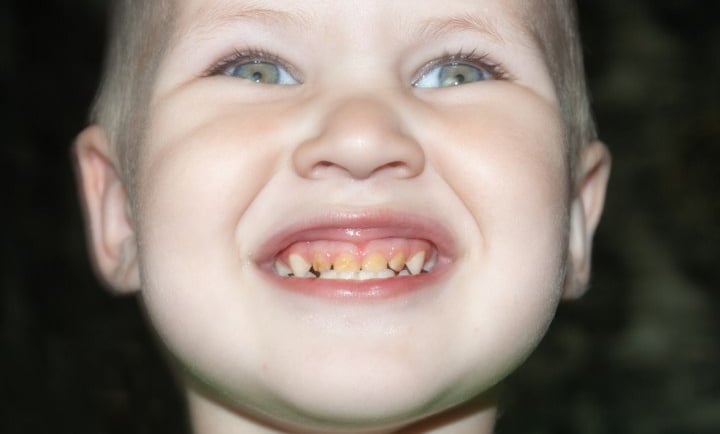 a smiling child anterior teeth affected by caries 