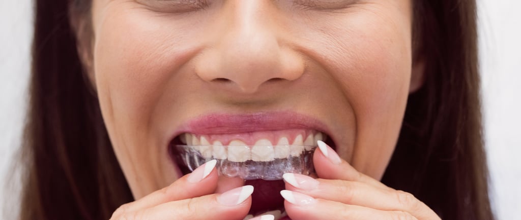 a person wearing clear aligner depicting advantages of using clear aligners