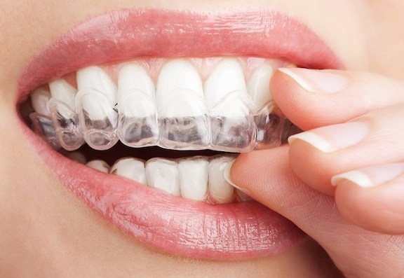 a person wearing clear aligners 