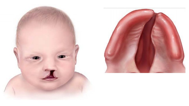 a child face with cleft lip and palate