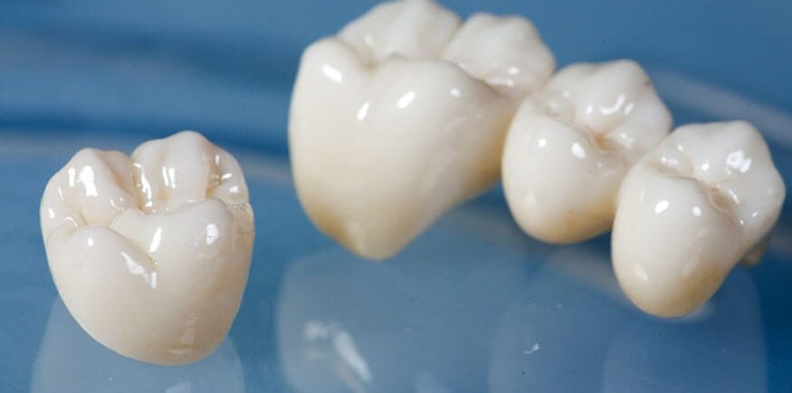 an imge showing dental bridge 