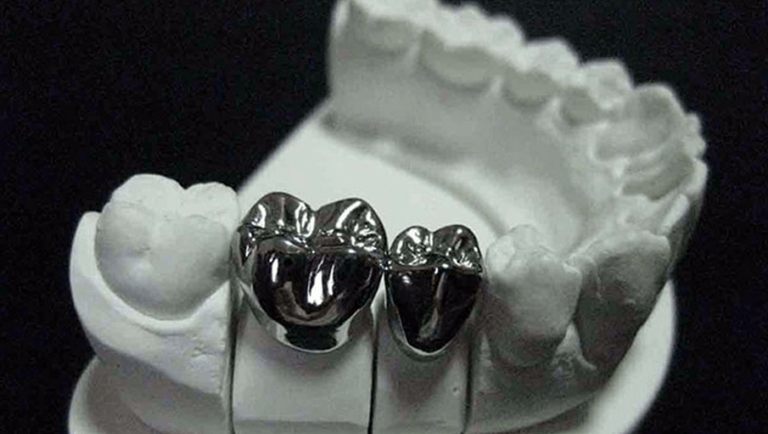 A Mettalic dental crown is placed on teeth
