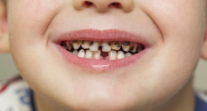 a image showing caries in all anterior teeth in kids mouth