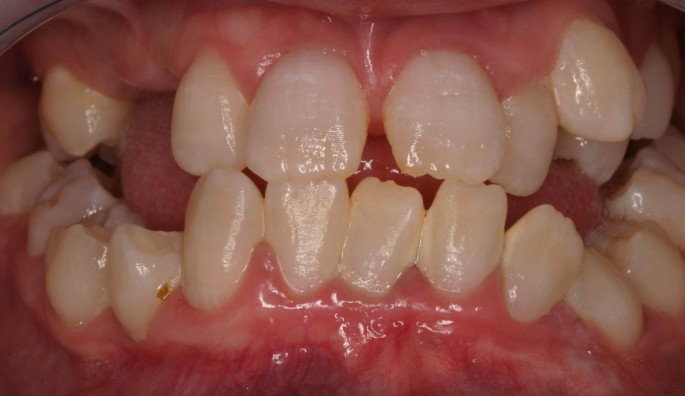 a image showing teeth with dentin dysplasia