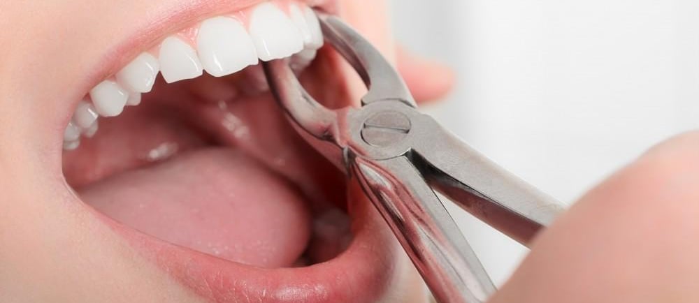 a tooth is being removed with forceps