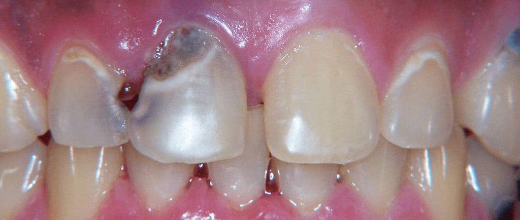 a image showing caries in incisors