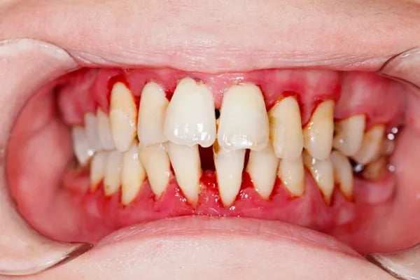 an image showing swollen gums 