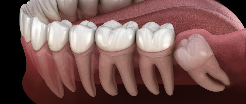 a image showing impacted wisdom teeth in the dental arch