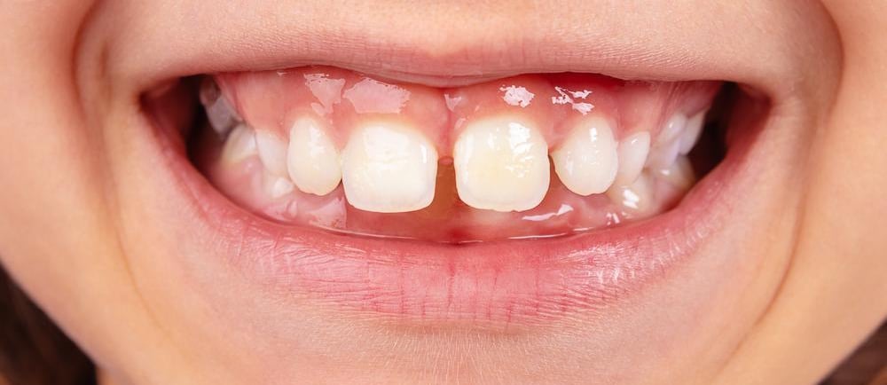 a image showing smiling teeth with gap between front upeer teeth