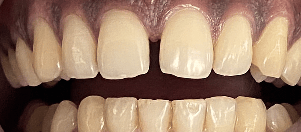 a image showing teeth with  midline diastema